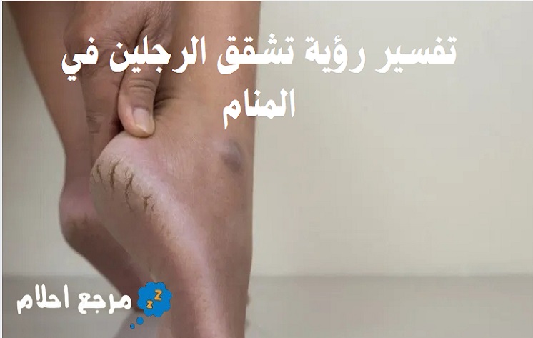 تفسير رؤية تشقق الرجلين في المنام والشعور بالألم