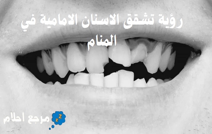 تفسير حلم رؤية تشقق الاسنان الامامية في المنام